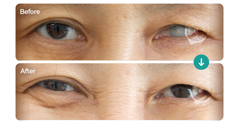 Ca lâm sàng 101284/TTMGVN – Mắt giả 3D Super Thin