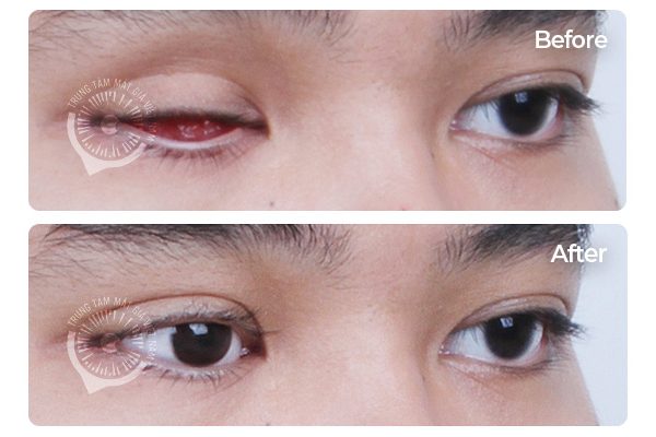 Hình ảnh két quả sau khi làm mắt giả cá nhân tại Trung Tâm Mắt Giả Việt Nam
