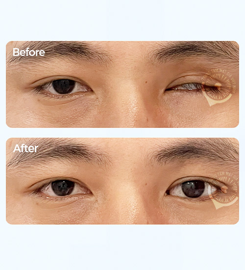Mắt Giả Cá Nhân 3D Plus ôm khít hốc mắt với độ chính xác cao - Matgia.com