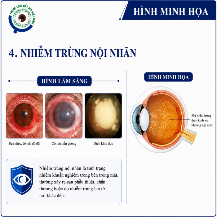 Nhiễm trùng nội nhãn có thể dẫn đến tổn thương mắt và khiếm khuyết nhãn cầu