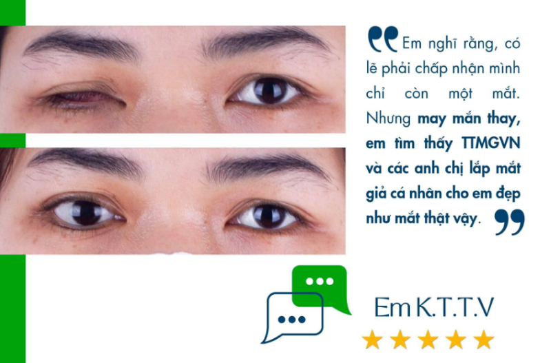 Phục hình mắt giả cá nhân cho người khiếm khuyết nhãn cầu