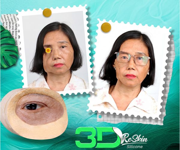 Phục hồi vùng mắt tổn thương bằng Mắt Giả Cá Nhân 3D Reskin Silicone