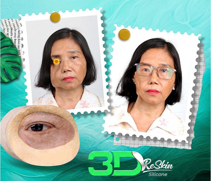 Phục hồi vùng mắt tổn thương bằng Mắt Giả Cá Nhân 3D Reskin Silicone