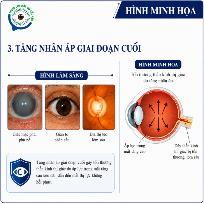 Tăng nhãn áp giai đoạn cuối có thể gây tổn thương nhãn cầu nghiêm trọng