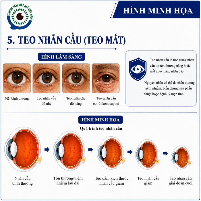 Teo nhãn cầu và giải pháp phục hình mắt giả cá nhân 3D
