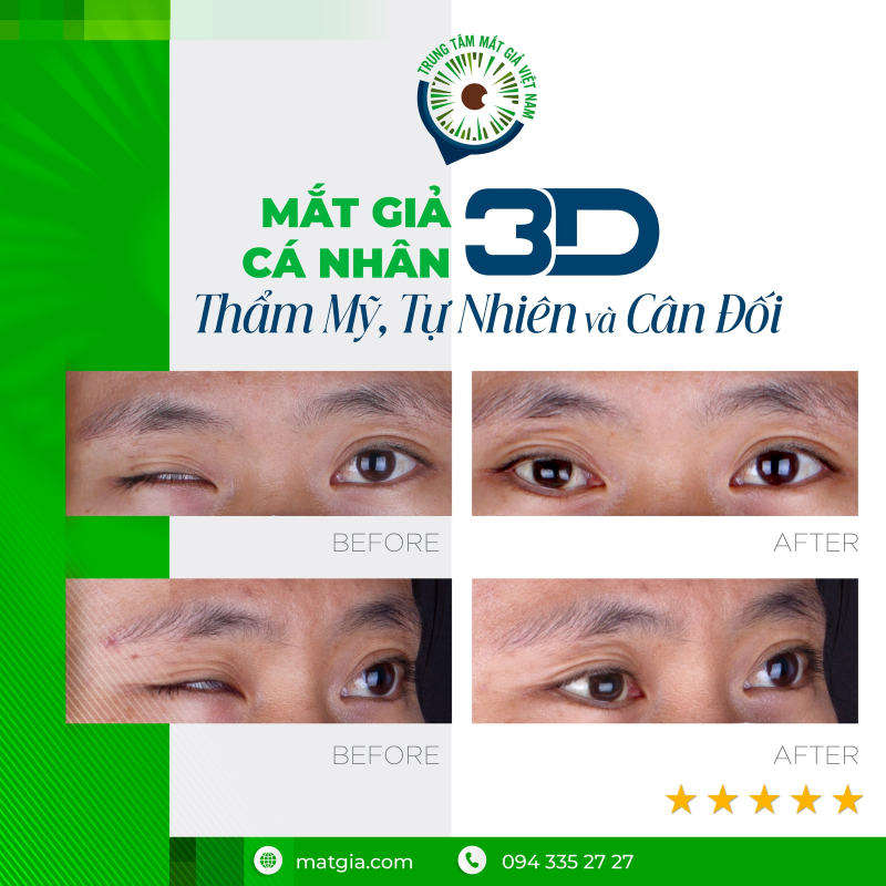 Tình trạng khiếm khuyết nhãn cầu cần được phục hình mắt giả cá nhân