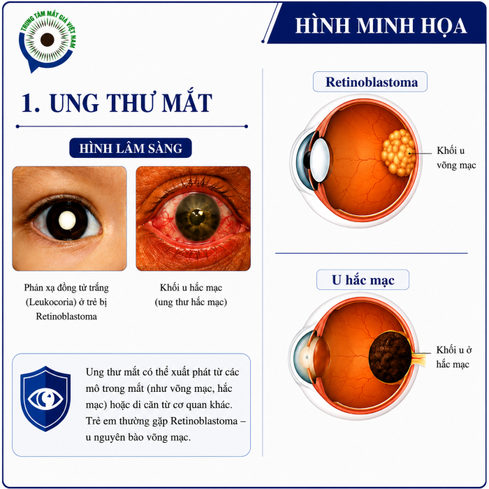 Ung thư mắt và phục hình mắt giả tại Trung Tâm Mắt Giả Việt Nam