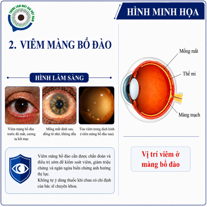 Viêm màng bồ đào nặng có thể ảnh hưởng nghiêm trọng đến nhãn cầu